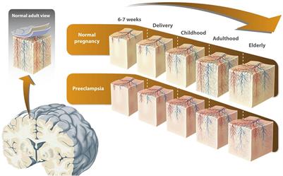 Are the Cognitive Alterations Present in Children Born From Preeclamptic Pregnancies the Result of Impaired Angiogenesis? Focus on the Potential Role of the VEGF Family